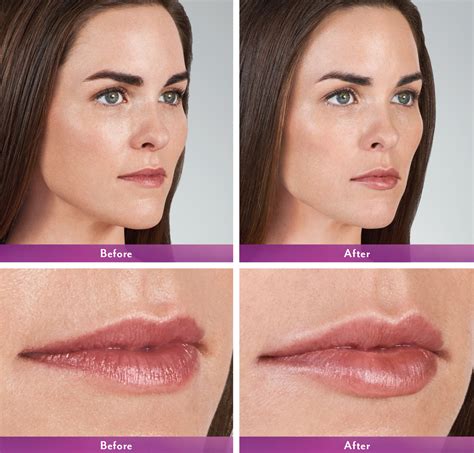 Kiral Best What Juvederm Is Best For Lips