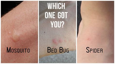 A Bed Bug How To Tell A Mosquito Bite From A Bed
