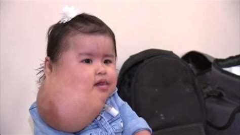 1 Year Old New York City Girl With Rare Neck Growth Has Surgery Abc7