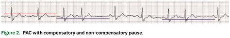 Premature Atrial Contractions Vs Premature Ventricular Contractions