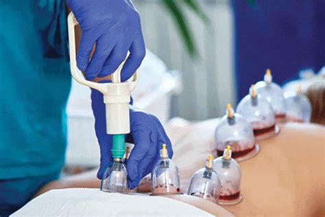 Cupping Therapy Natural Therapy Process For Body Hijama Singapore