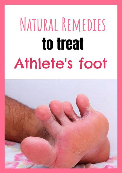 Athletes Foot 6 Natural Remedies To Treat This Fungal Infection