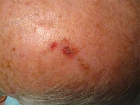Actinic Keratosis Treatment For Skin Lesions And Abnormal Growths