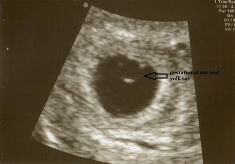 The gestational sac increases in diameter by 1.13 mm per day and initially. Praying for a Rainbow: November 2012