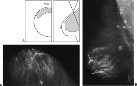 Interpreting The Mammogram Radiology Key