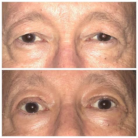 Before And After Photos Ptosis Repair Ellevate Md