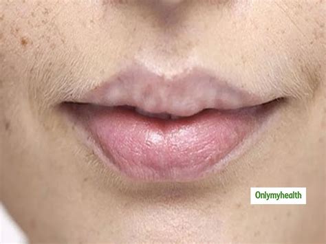 Small White Spots In Lips