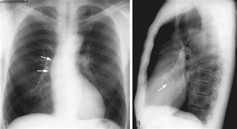 Aortic Stenosis Chest X Ray Wikidoc
