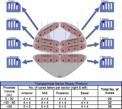 Transperineal Sector Prostate Biopsies A Local Anesthetic Outpatient