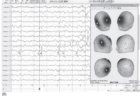 Eeg Interpretation In Childhood Epilepsies Neupsy Key