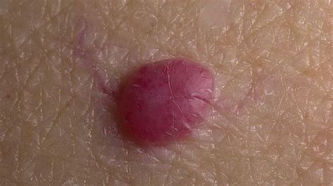 How Common Are Hemangiomas In Adults Красные цветы