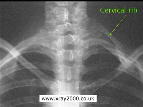 Rib Cervical Causes Symptoms Treatment Rib Cervical
