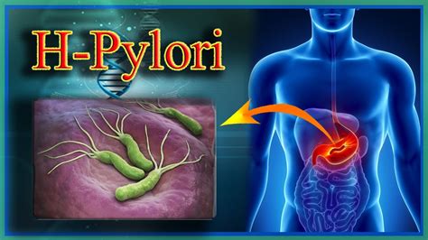 H Pylori Test By Harib Diagnostic Lab Youtube