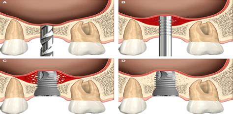 What Is Sinus Lift Surgery For Dental Implants Do I Need One Us Dental