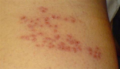 Shingles Symptoms And What You Need To Know