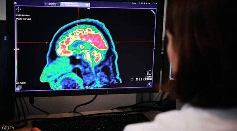 دراسة تكشف عن حقائق صادمة بشأن إصابات الدماغ