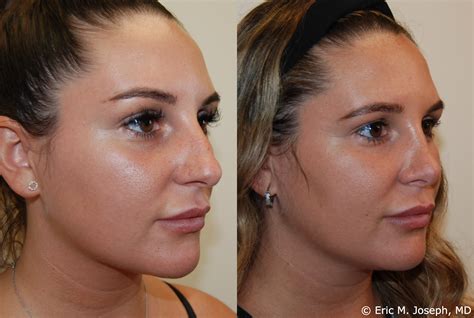 Eric M Joseph Md Rhinoplasty Before After Profile Bump And