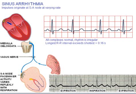 As with other cardiovascular problems, the primary treatment offered to patients with irregular heartbeat involves the use of pharmaceutical drugs. Sinus Arrhythmia | Sinusitis, Medical mnemonics, Health ...