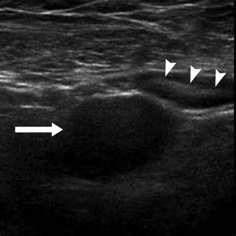 Axillary Lymph Nodes Suspicious For Breast Cancer Metastasis Sampling