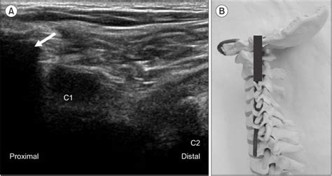 Cervical Mass Ultrasound