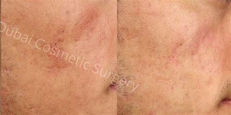 Acne Scar Treatment In Dubai Uae Dubai Cosmetic Surgery Images