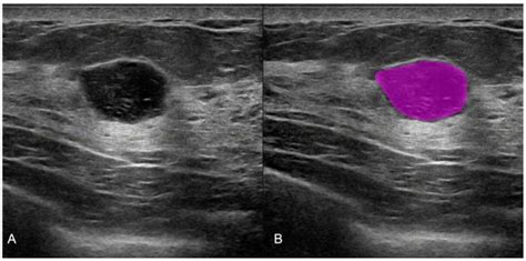 cancers free full text prediction of the malignancy of a breast lesion detected on breast