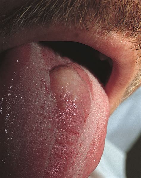 A Painless Mass On The Tongue Of A Young Man Jama Dermatology Jama