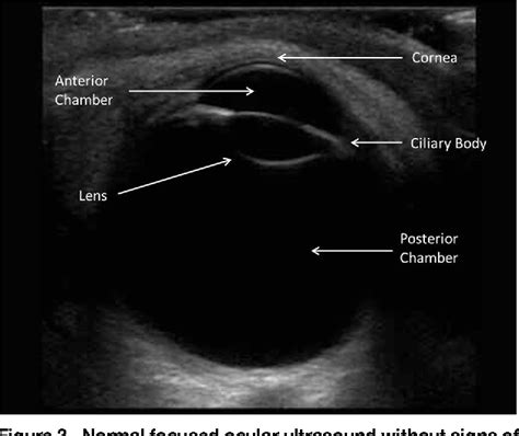 Figure 2 From A Sonographic Sign Of Papilledema Semantic Scholar