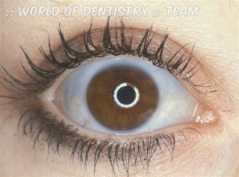World Of Dentistry Blue Sclera Definition And