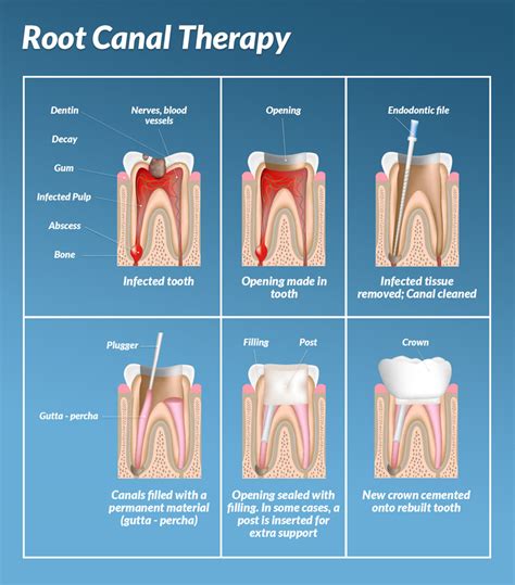 Endodontic Treatment Dentist Neutral Bay L Shore Dental