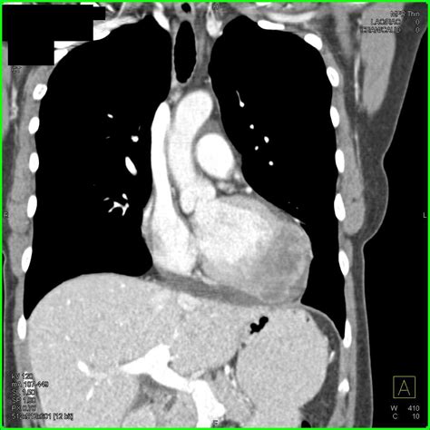 Angiosarcoma Involves The Left Ventricle Cardiac Case Studies