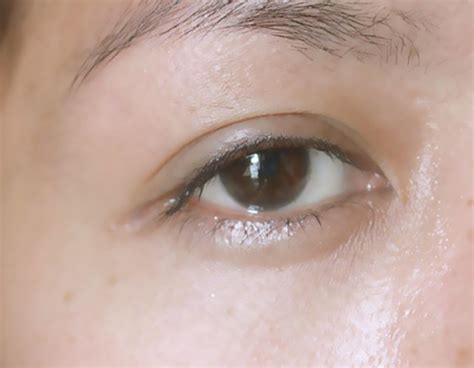 Puffy Eyelids Symptoms Causes Treatment Remedies Hubpages