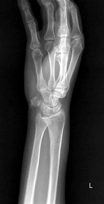 Oblique View Of Left Wrist Plain Radiography Showing Small Irregular