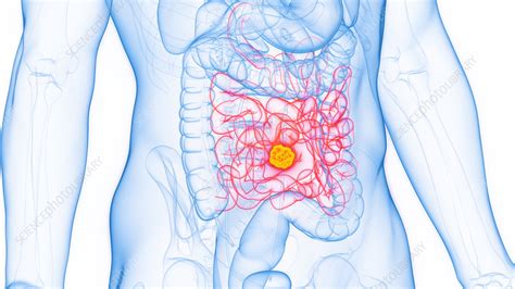 cancer of the small intestine illustration stock image f038 0344 science photo library