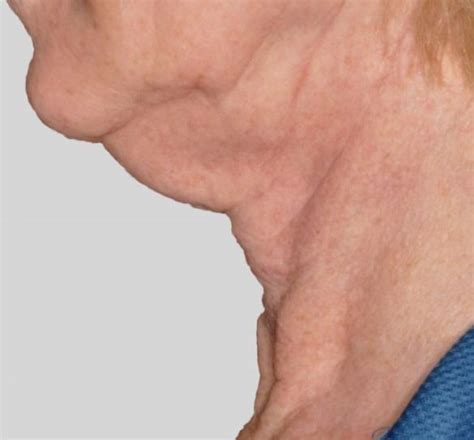 Saggy Neck Causes Non And Surgical Treatments Skincarederm