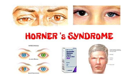 Horners Syndrome Horners Syndrome Anatomy Horners Syndrome Causes Youtube