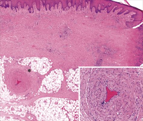 It represents up to 15% of the leg ulcers hospitalized in a dermatology ward. Martorell Hypertensive Ischemic Leg Ulcer: A Model of ...