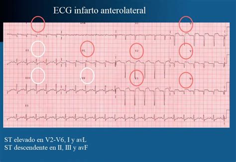 Infarto Agudo De Miocardio Ecg Diagn Stico Inferior Enzimas Y