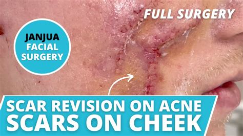 SCAR REVISION ON ACNE SCARS ON CHEEK LIVE SURGERY DR TANVEER