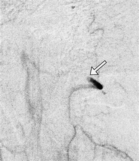 Vertebral Artery Dissection Spectrum Of Imaging Findi Vrogue Co