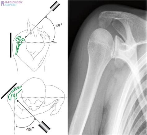 Shoulder X Ray Positions