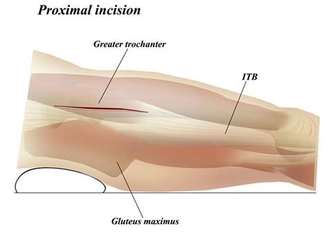 Femur Lateral Approach Approaches Orthobullets