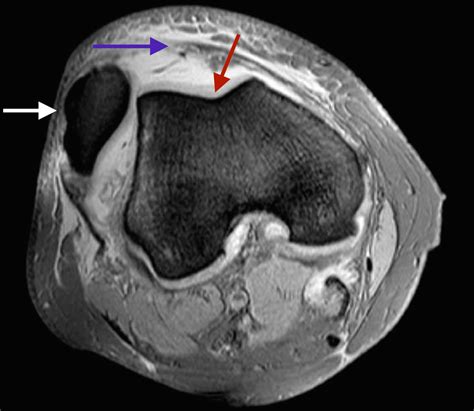 Knee Muscle Anatomy Axial Mri Magnetic Resonance Imaging Knee Injury