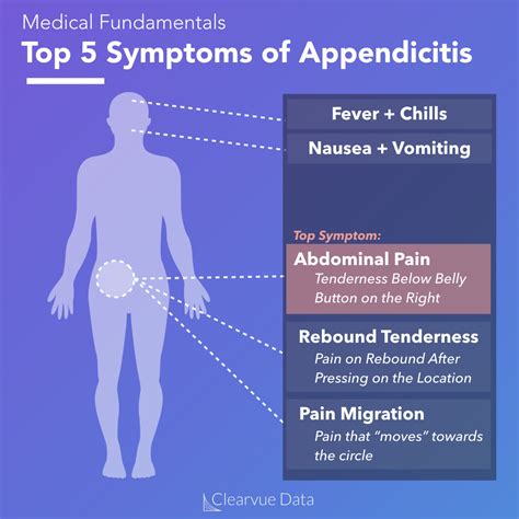 Appendicitis Diagram