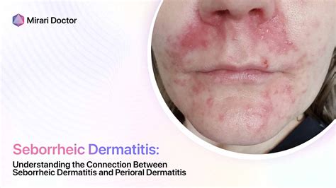 Understanding The Connection Between Seborrheic Dermatitis And Perioral Dermatitis