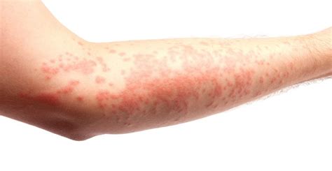 Erythema Types Causes Symptoms And Treatments