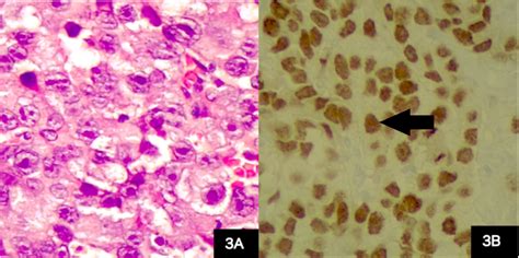 Cureus Unclassified Mixed Germ Cell Sex Cord Stromal Tumor Of The Ovary An Unusual Case Report