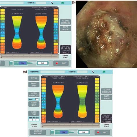 Pdf Endoflip System For The Intraoperative Evaluation Of Peroral