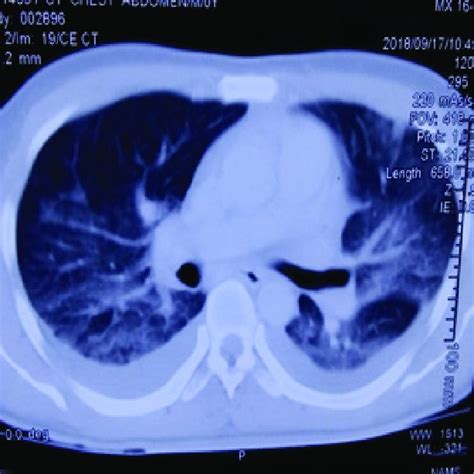 Ct Chest Showing Ground Glass Opacities With Bilateral Minimal Pleural