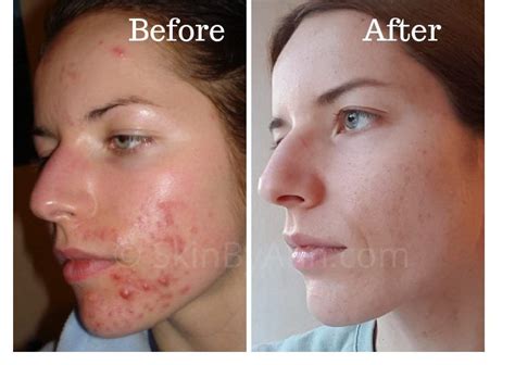 My Cystic Acne Before And After Photo Cystic Acne Acne How To Get